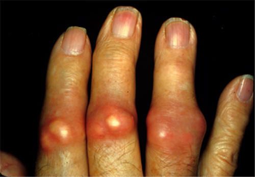 Inflamed_tophaceous_gout_zpsgdmf9miv.jpg