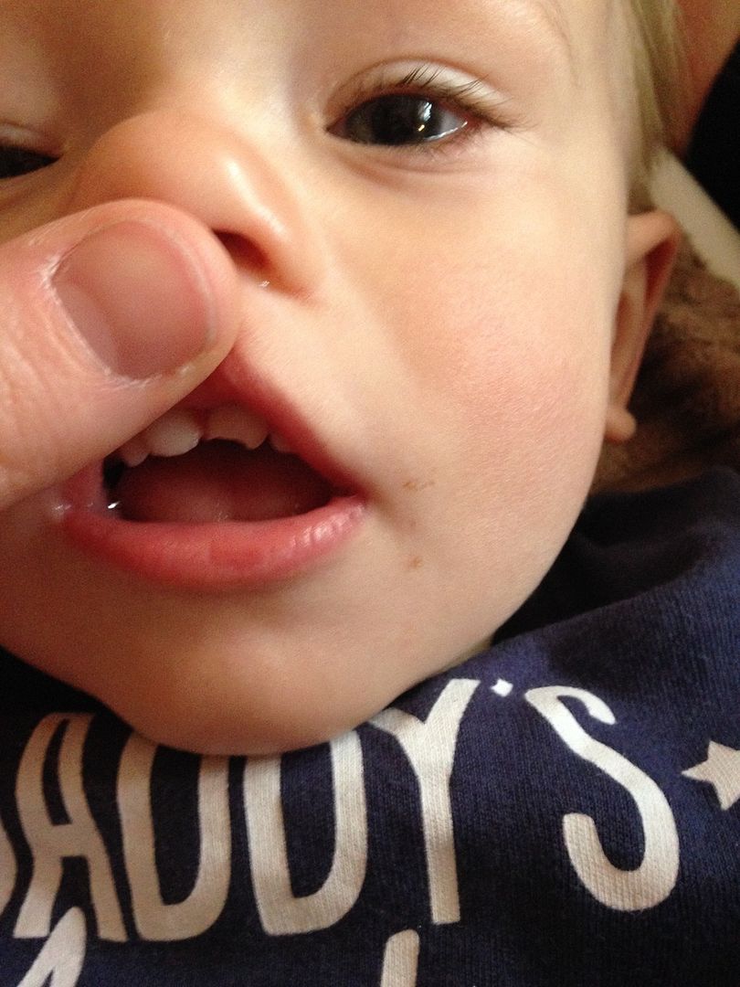 Gutted! My boy chipped his tooth! BabyCentre